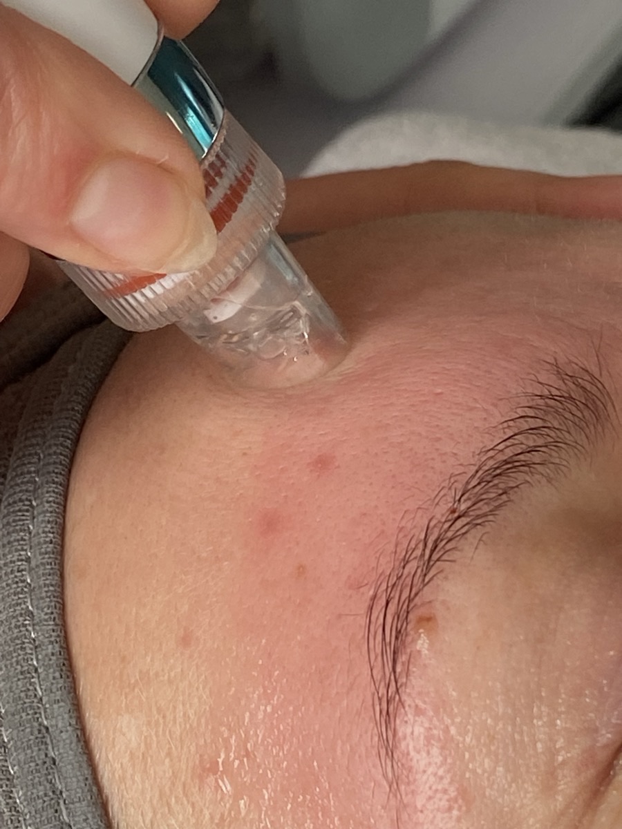 Hydrodermabrasion during a Hydrofacial Plus treatment at Floatwell Cambridge